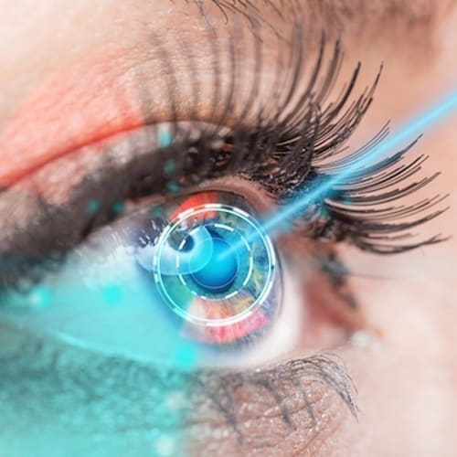 Cirugía Lasik
