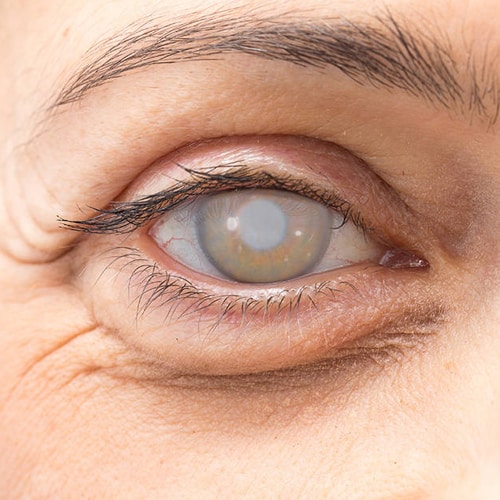 Cirugía de Cataratas