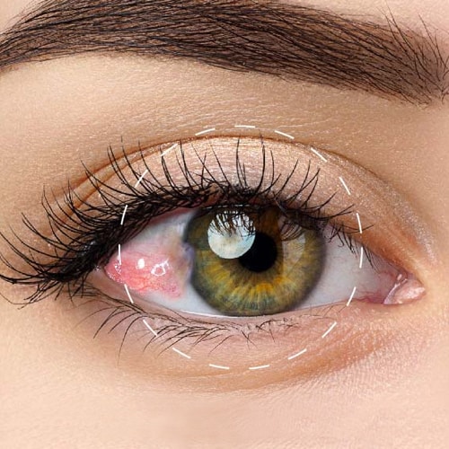 Cirugía de Pterigion