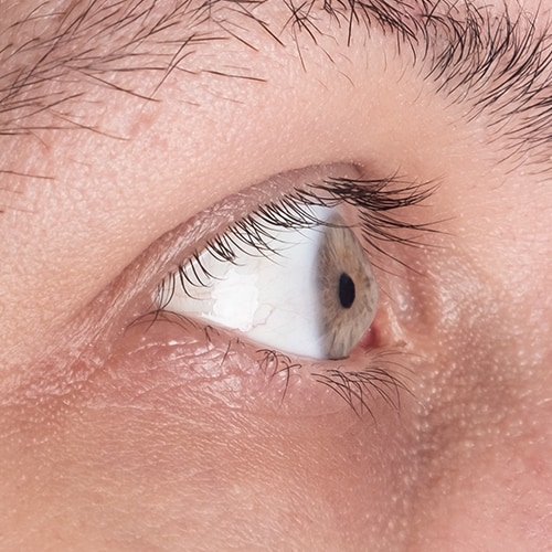 Cirugía de Queratocono