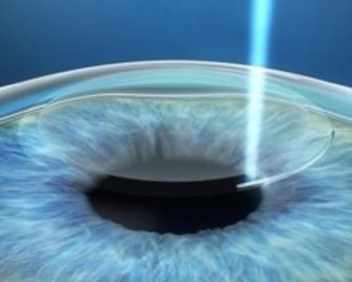 Cirugía Relex Smile